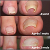 Dernier Jour -50% | PediPatch™ Patches de correction des ongles (100 pièces)