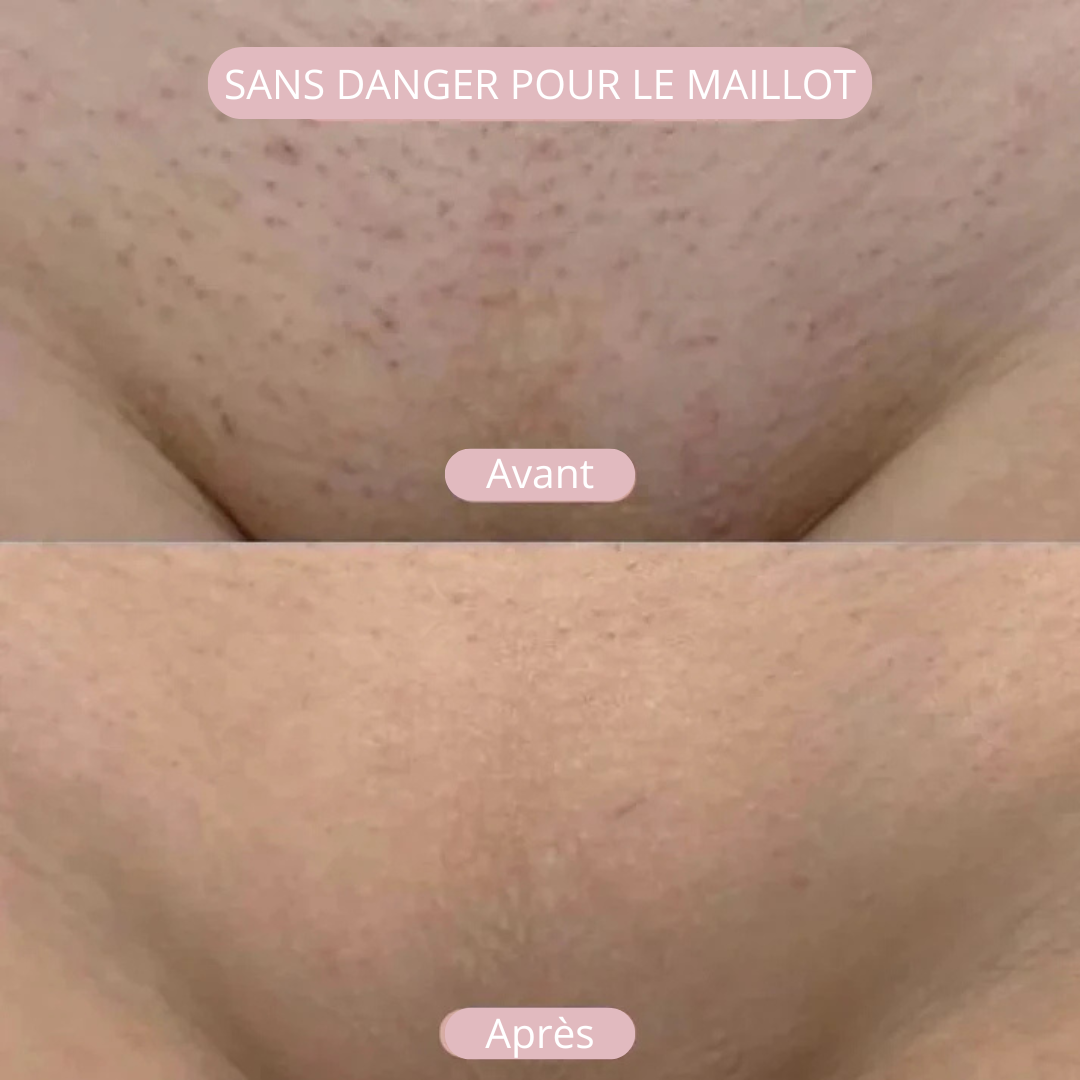 Dernier Jour -50%🔥 | NuitLisse™ Épilation sans douleur pour une peau parfaitement lisse !