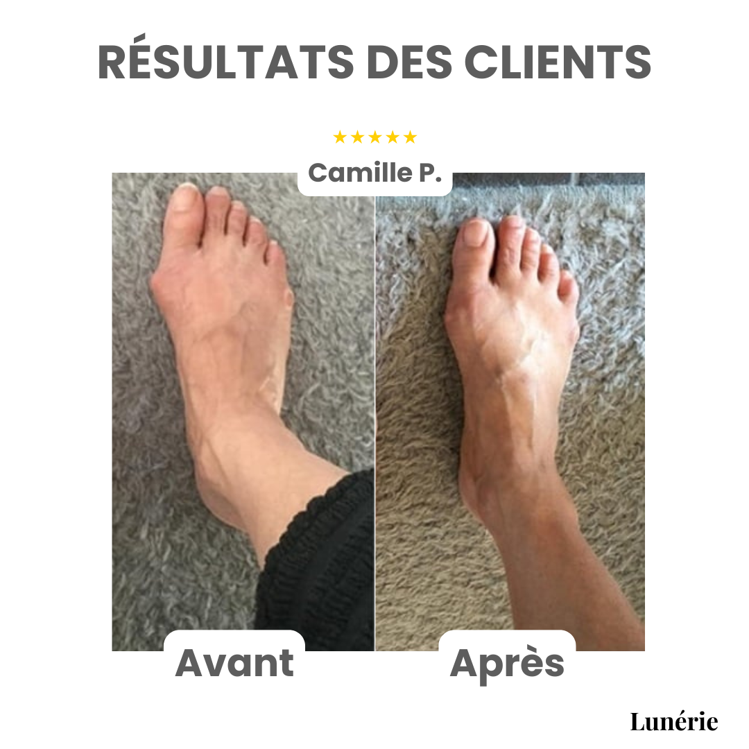 Dernier Jour -50% | ToeAlign™ Correcteur pour Hallux Valgus