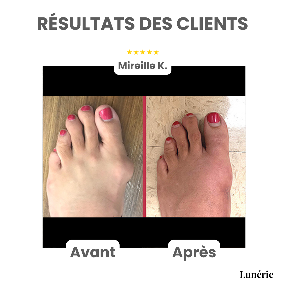 Dernier Jour -50% | ToeAlign™ Correcteur pour Hallux Valgus