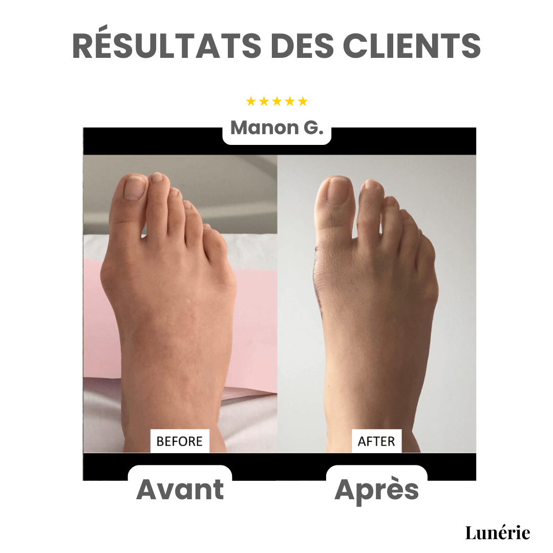 Dernier Jour -50% | ToeAlign™ Correcteur pour Hallux Valgus