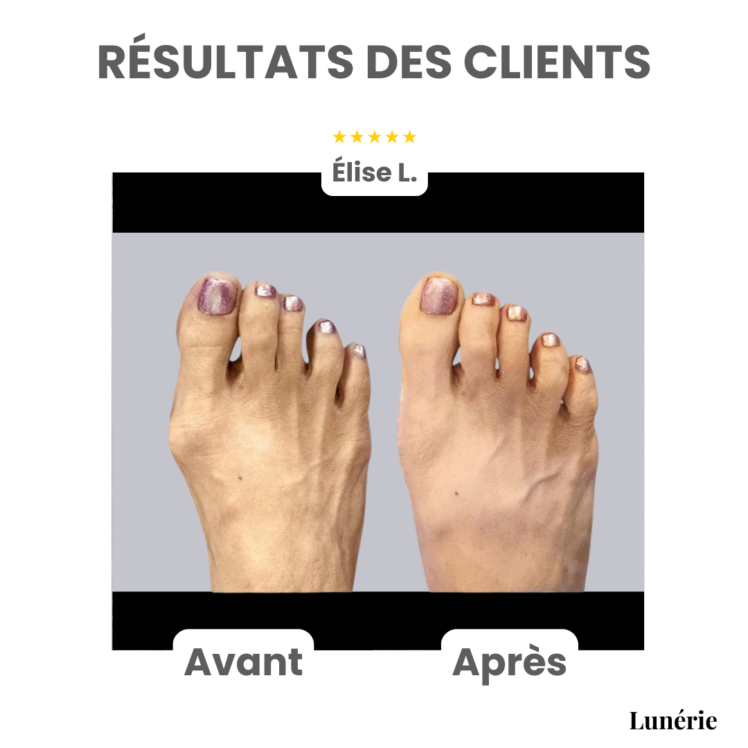 Dernier Jour -50% | ToeAlign™ Correcteur pour Hallux Valgus