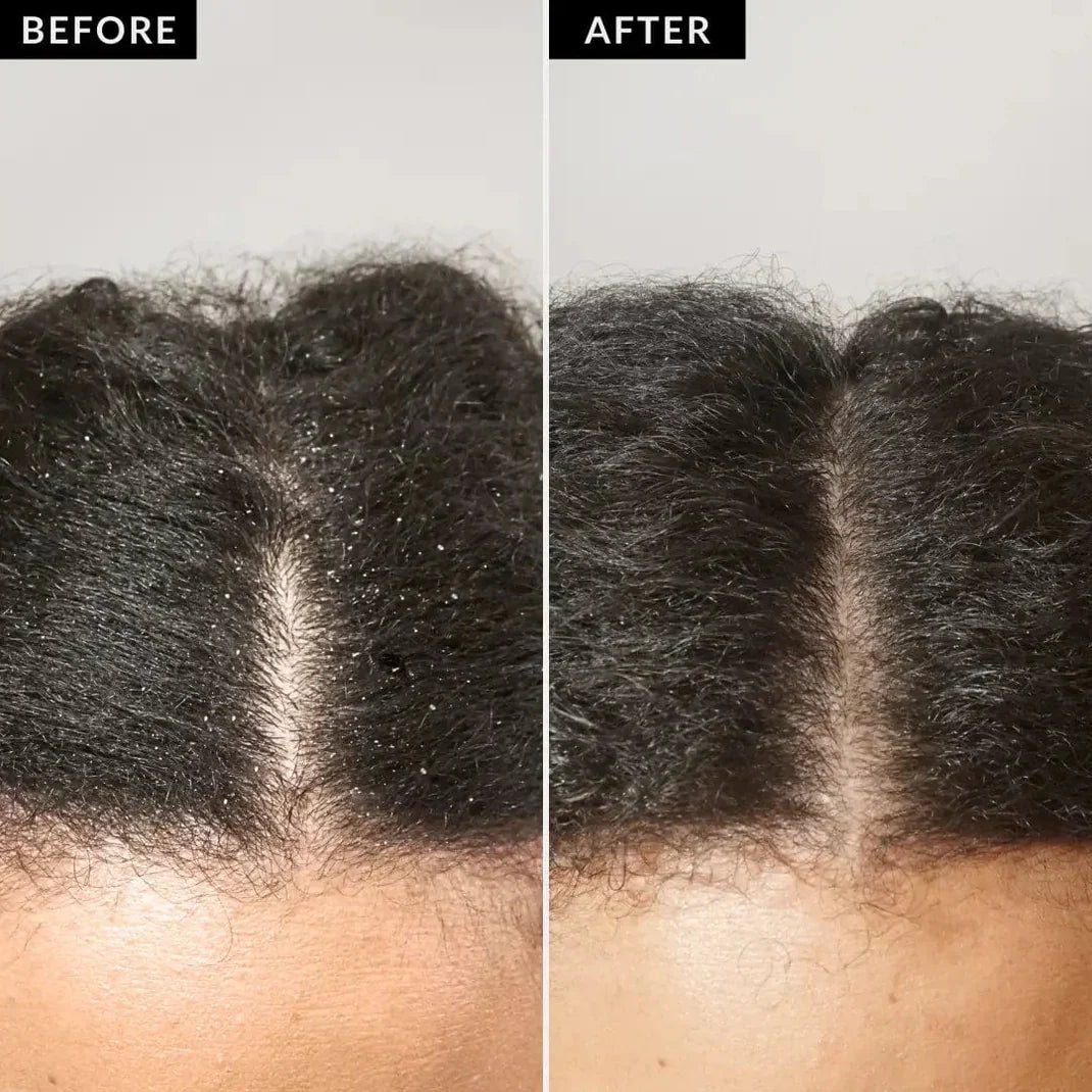 Dernier Jour -50% | RootRevive™ Peigne Détox Cuir Chevelu